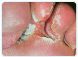 Athletes Foot